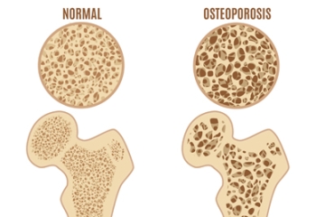 Infographic: Osteoporosis: A Top 10 Killer of Women (That No One’s Talking About)