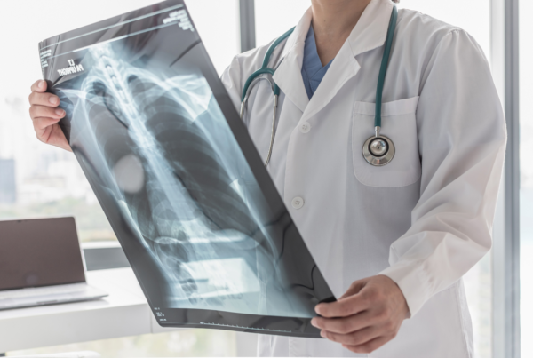 A doctor holds a chest Xray of a patient who quit smoking to reduce their risk of lung cancer.