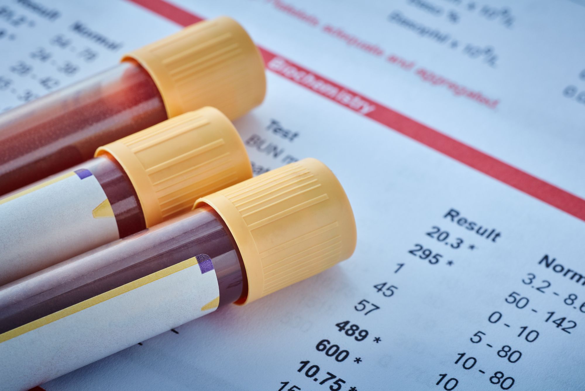 ApoB blood test vial being drawn to assess cardiovascular risk.